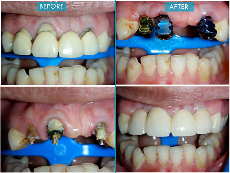 Conventional Dental Implants