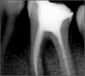 Root Canal Treatment Clinic Jalandhar in Punjab