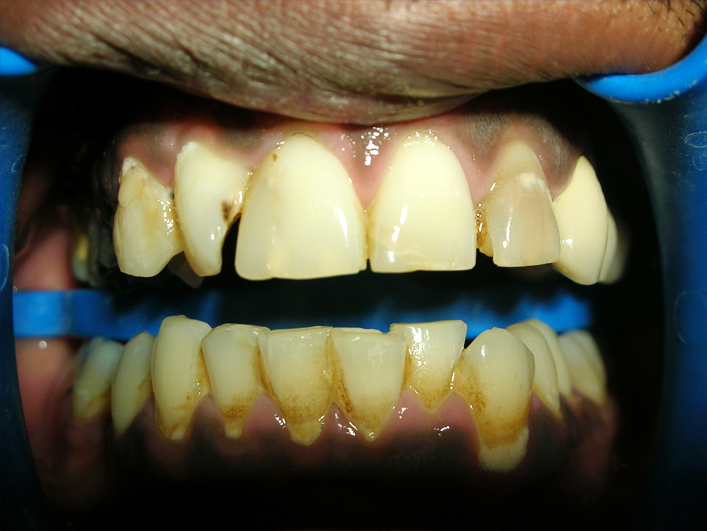 Dental Veneers  Treatment Clinic Jalandhar